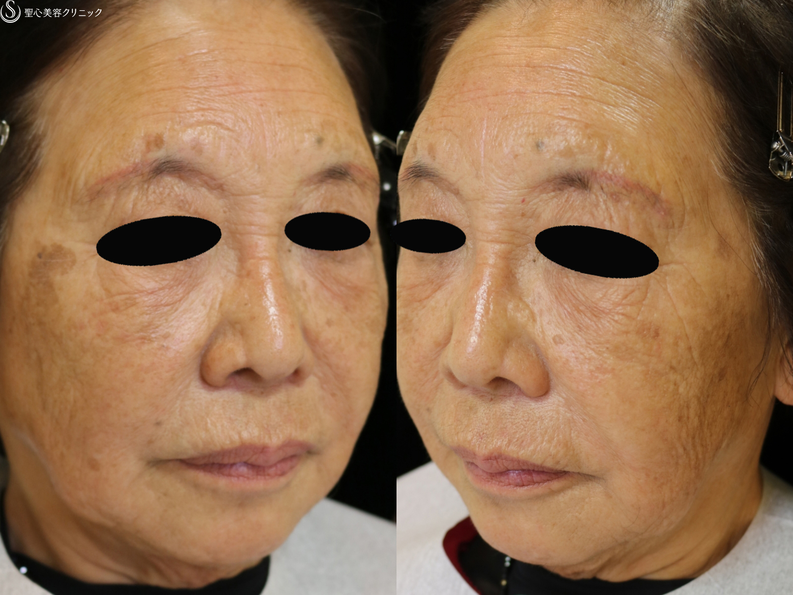 【80代女性・全顔の若返り】プレミアムPRP皮膚再生療法（4年5ヶ月後） After 