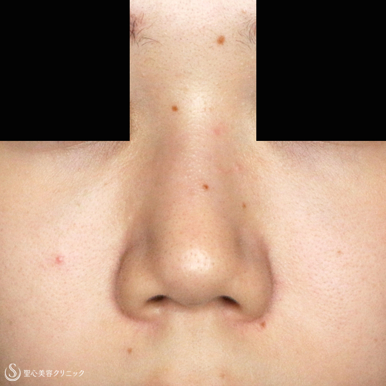 【20代女性・画期的な鼻のプチ整形】Gメッシュ（4本）単独（処置直後） Before 
