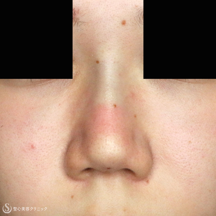 【20代女性・画期的な鼻のプチ整形】Gメッシュ（4本）単独（処置直後） After 