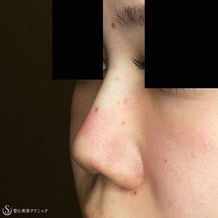 【20代女性・画期的な鼻のプチ整形】Gメッシュ（4本）単独（処置直後） After 