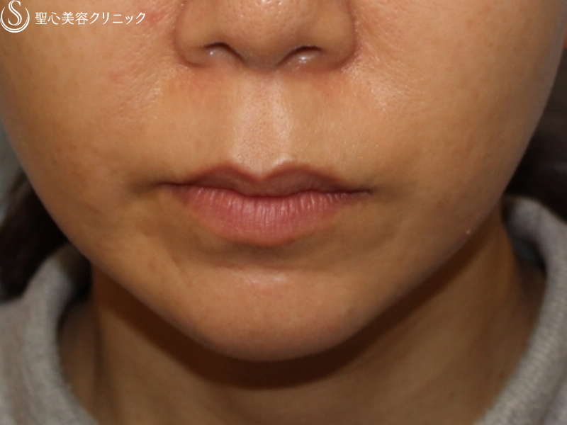 30代女性 鼻の下を短く リップリフト 1年後 症例写真 美容整形 美容外科なら聖心美容クリニック