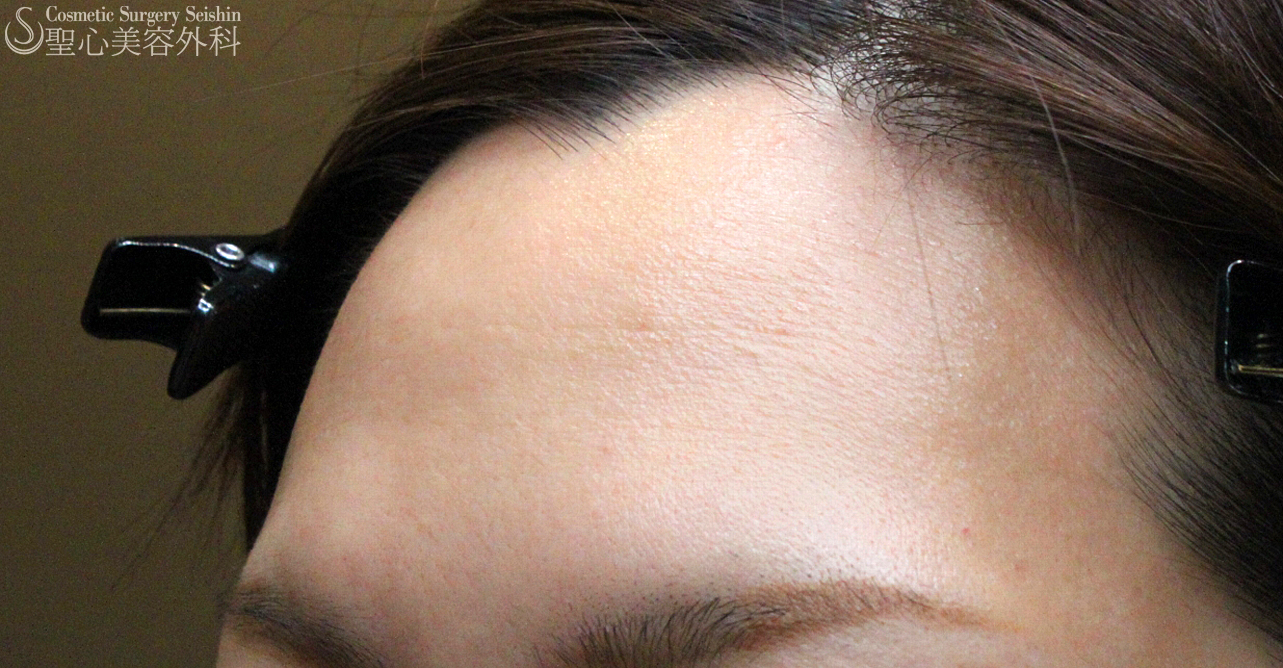 【30代女性・女性らしい丸いオデコ】プレミアムPRP皮膚再生療法（7年後） Before 