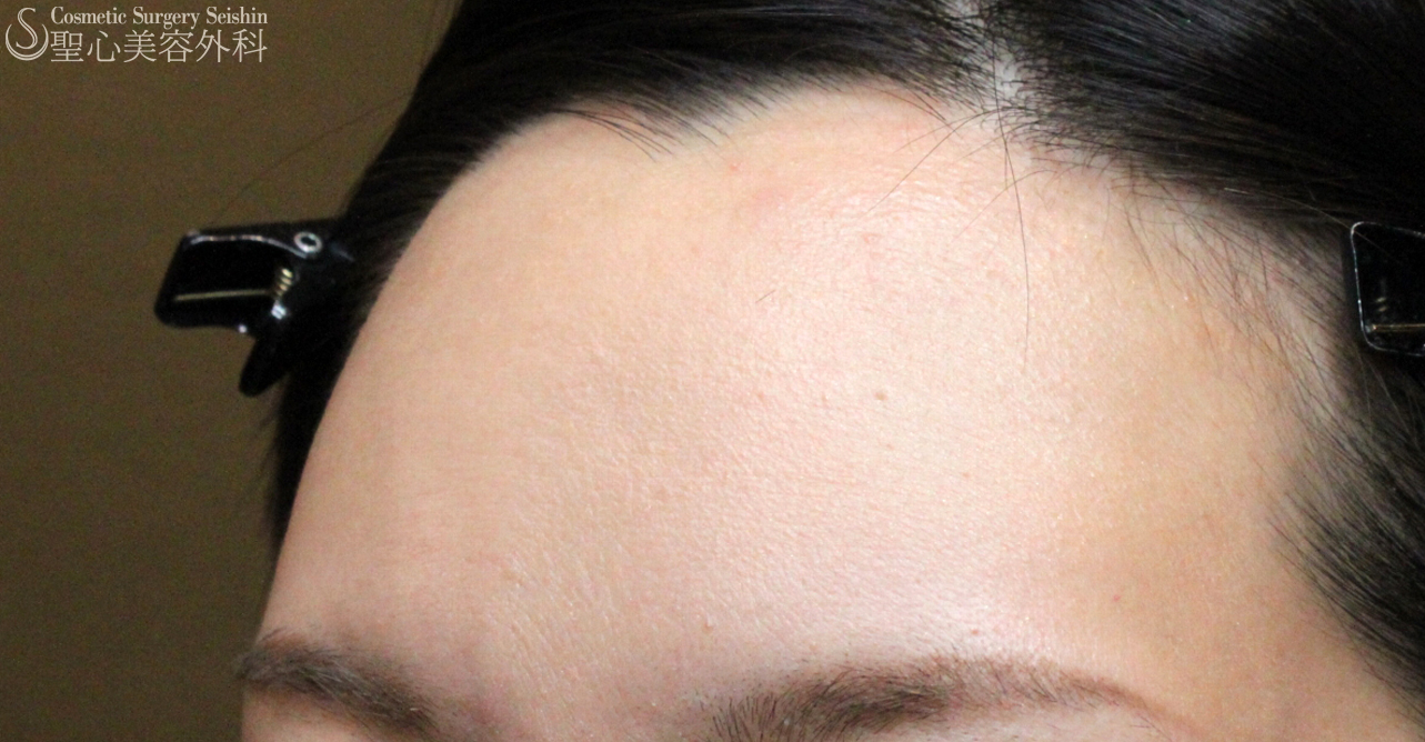 【30代女性・女性らしい丸いオデコ】プレミアムPRP皮膚再生療法（7年後） Before 