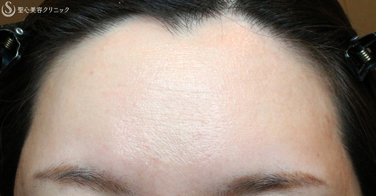 【30代女性・女性らしい丸いオデコ】プレミアムPRP皮膚再生療法（7年後） After 