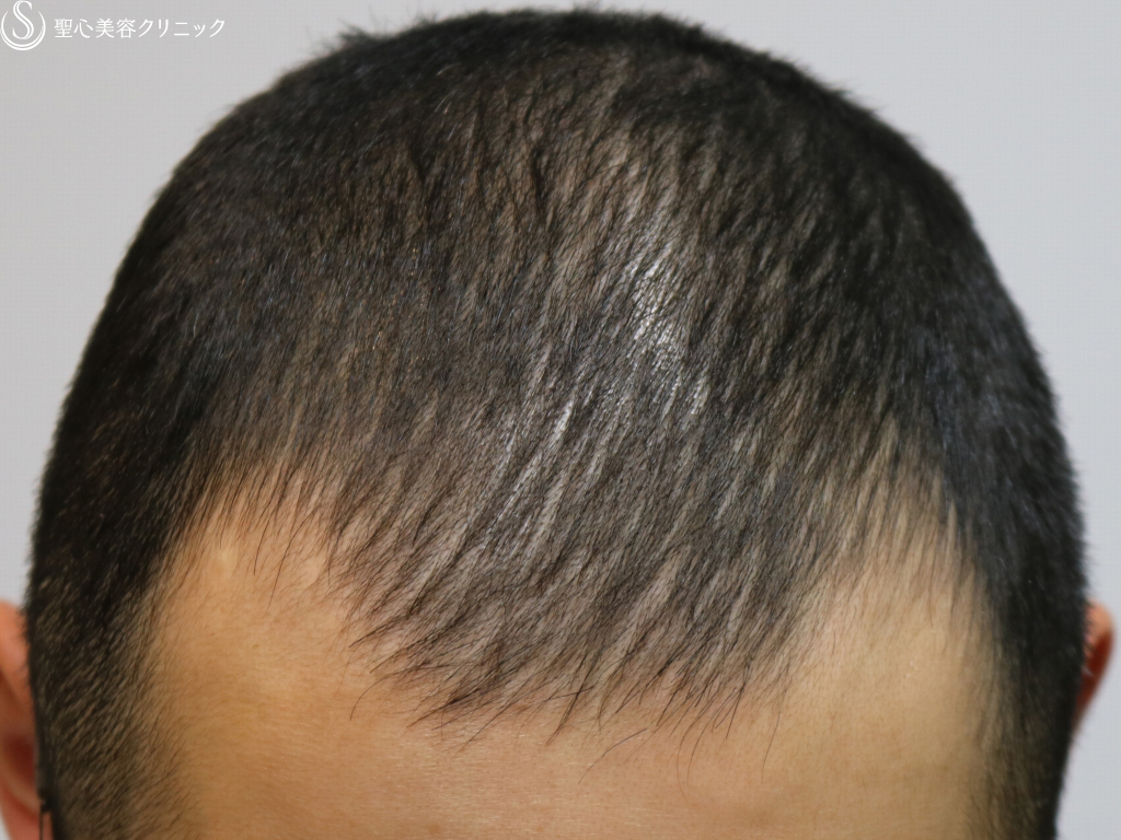 【30代男性・頭皮のコンディションが改善】男性の薄毛治療（3ヶ月後） After 