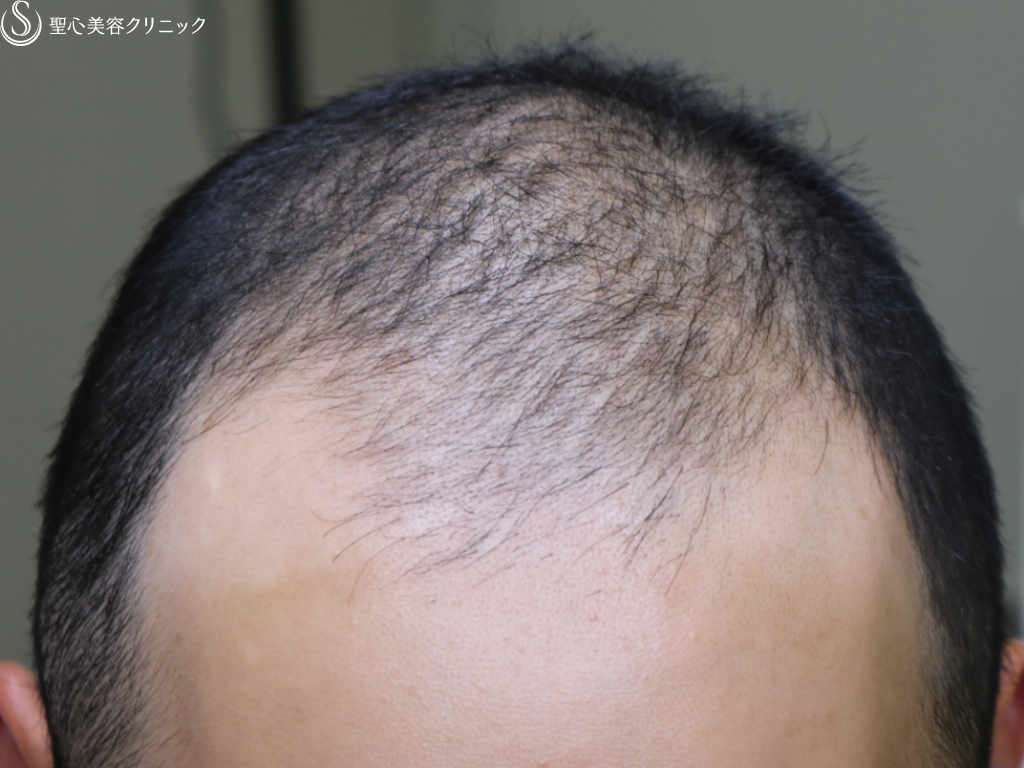 【30代男性・頭皮のコンディションが改善】男性の薄毛治療（3ヶ月後） Before 