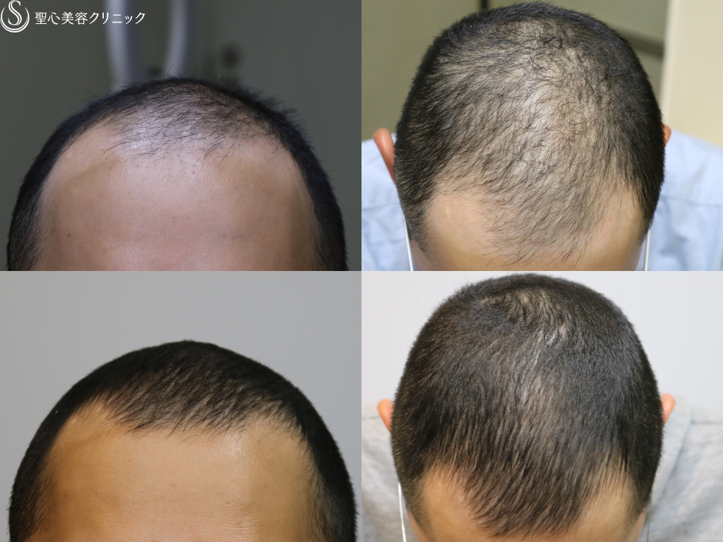 【30代男性・頭皮のコンディションが改善】男性の薄毛治療（3ヶ月後） After 
