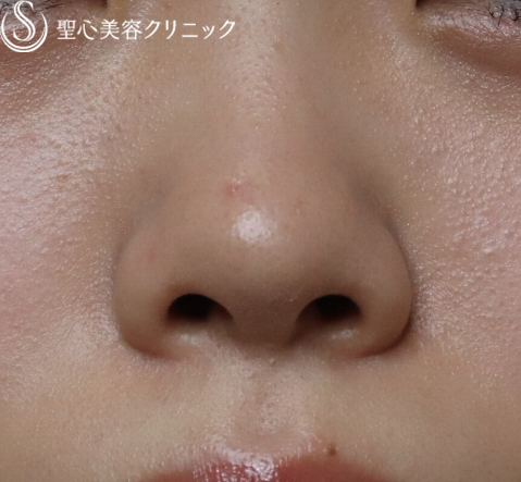 【20代女性・耳の軟骨で鼻の穴を目立たなく】鼻孔縁下降術（1ヶ月後） Before 