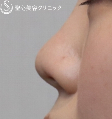 【20代女性・耳の軟骨で鼻の穴を目立たなく】鼻孔縁下降術（1ヶ月後） After 
