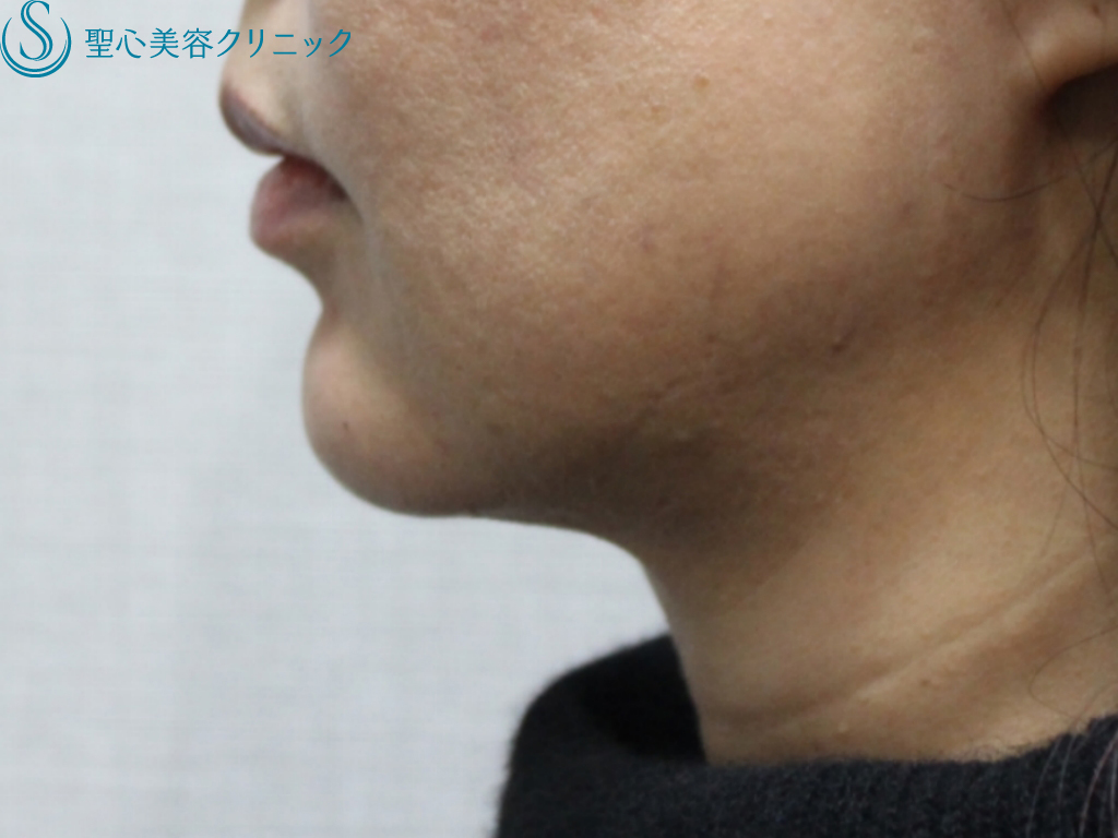 【40代女性・あご先が自然にシャープに】ヒアルロン酸注入 + Celluform+（セルフォーム・プラス）脂肪溶解注射（処置直後） After 