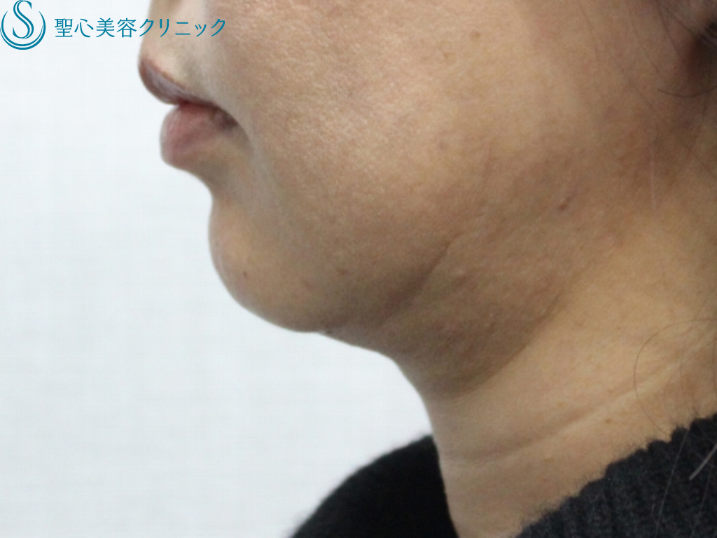 【40代女性・あご先が自然にシャープに】ヒアルロン酸注入 + Celluform+（セルフォーム・プラス）脂肪溶解注射（処置直後） Before 