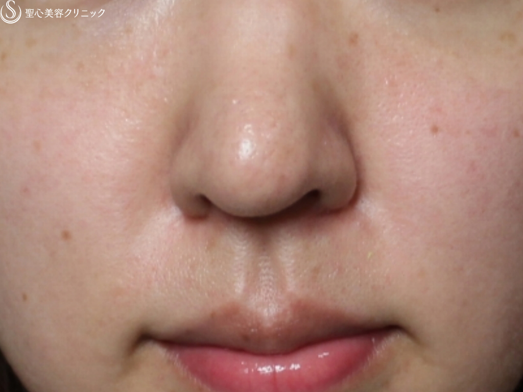 【20代女性・鼻先を自然に綺麗に】鼻尖縮小、耳介軟骨移植、小鼻縮小（1年後） After 