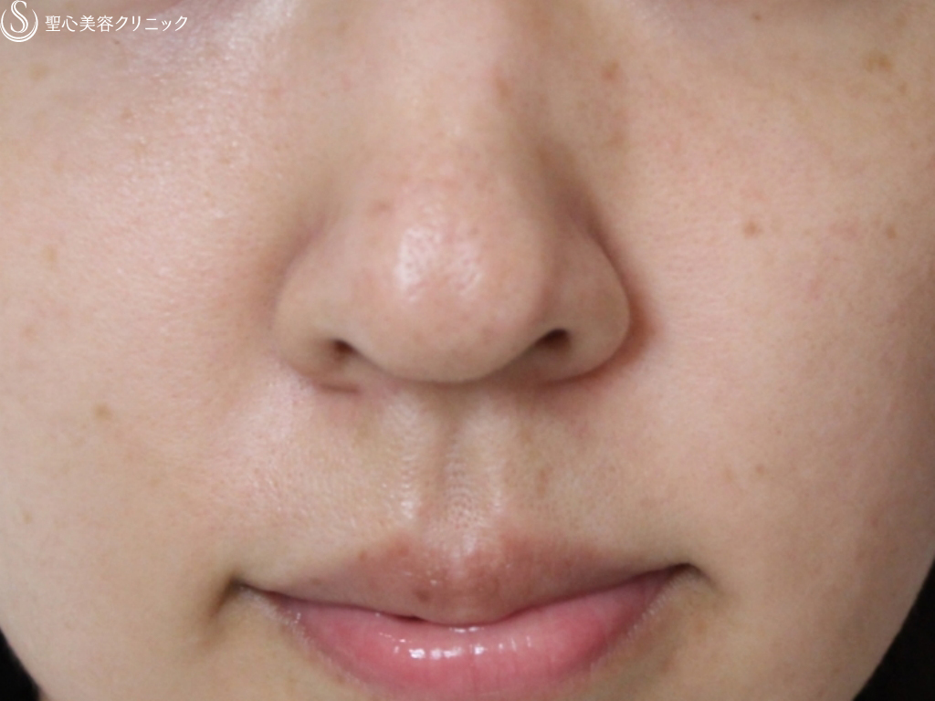 【20代女性・鼻先を自然に綺麗に】鼻尖縮小、耳介軟骨移植、小鼻縮小（1年後） Before 