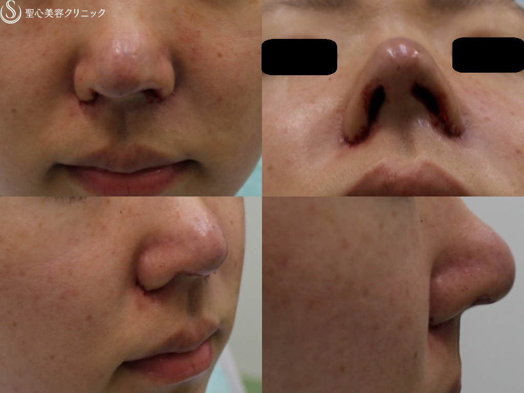 【20代女性・鼻先を自然に綺麗に】鼻尖縮小、耳介軟骨移植、小鼻縮小（1年後） After 