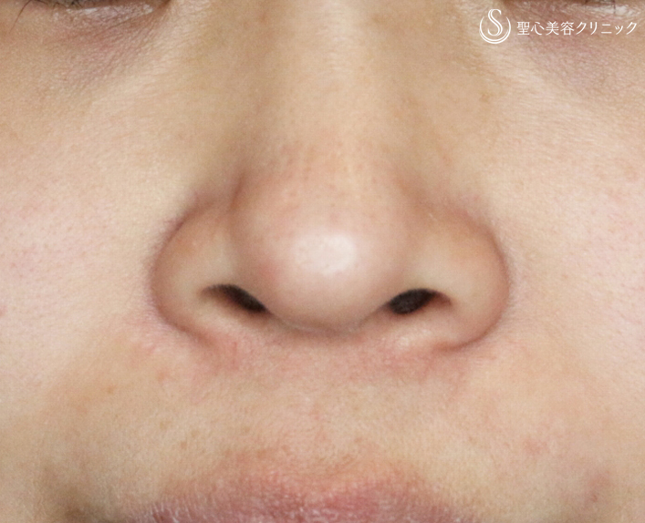 【30代女性・鼻の印象を消す】小鼻縮小術+α法（1ヶ月後） Before 