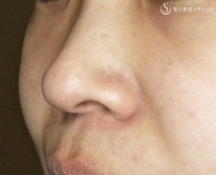 【30代女性・鼻の印象を消す】小鼻縮小術+α法（1ヶ月後） Before 