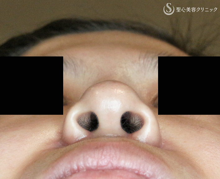 【30代女性・鼻の印象を消す】小鼻縮小術+α法（1ヶ月後） After 
