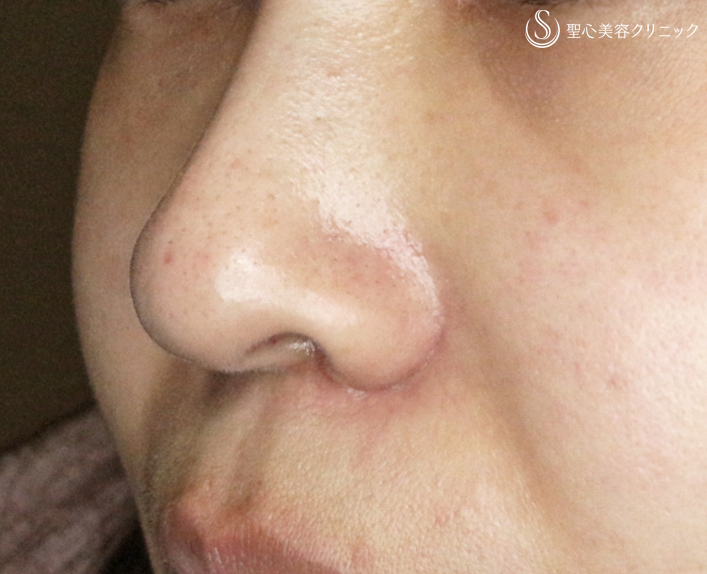 【30代女性・鼻の印象を消す】小鼻縮小術+α法（1ヶ月後） After 