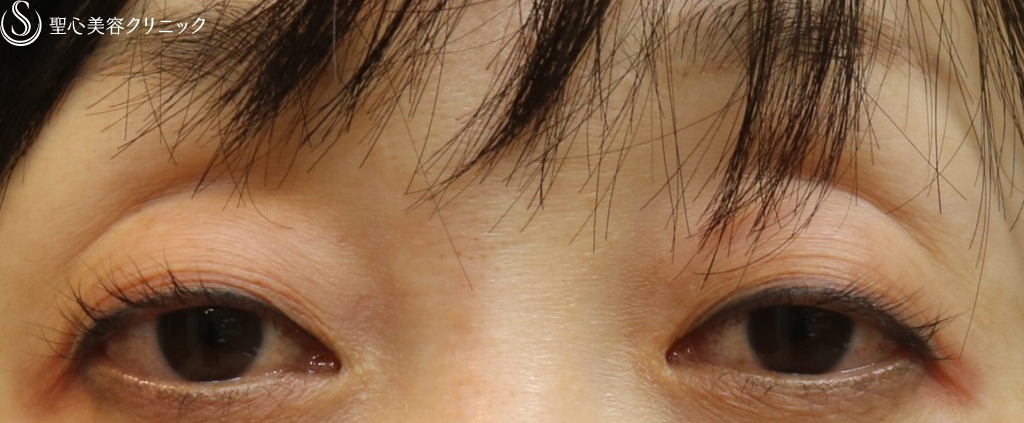 【40代女性・目の開きが良くなりました】眼瞼下垂（埋没法）（直後） Before 