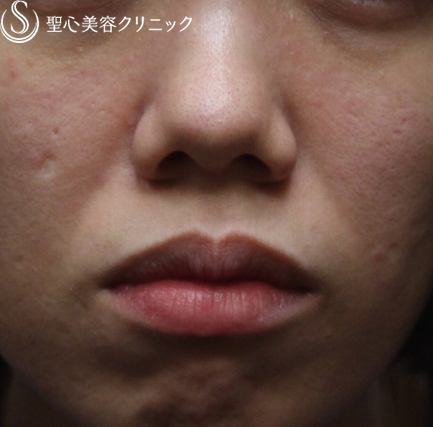 【30代女性・ほうれい線が目立たず、自然な若返り】プレミアムPRP皮膚再生療法（6ヶ月後） Before 