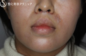 【女性・お顔全体が締まった印象に】鼻下短縮術でバランスを整える（1ヶ月後） After 