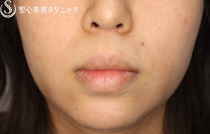 【女性・お顔全体が締まった印象に】鼻下短縮術でバランスを整える（1ヶ月後） Before 