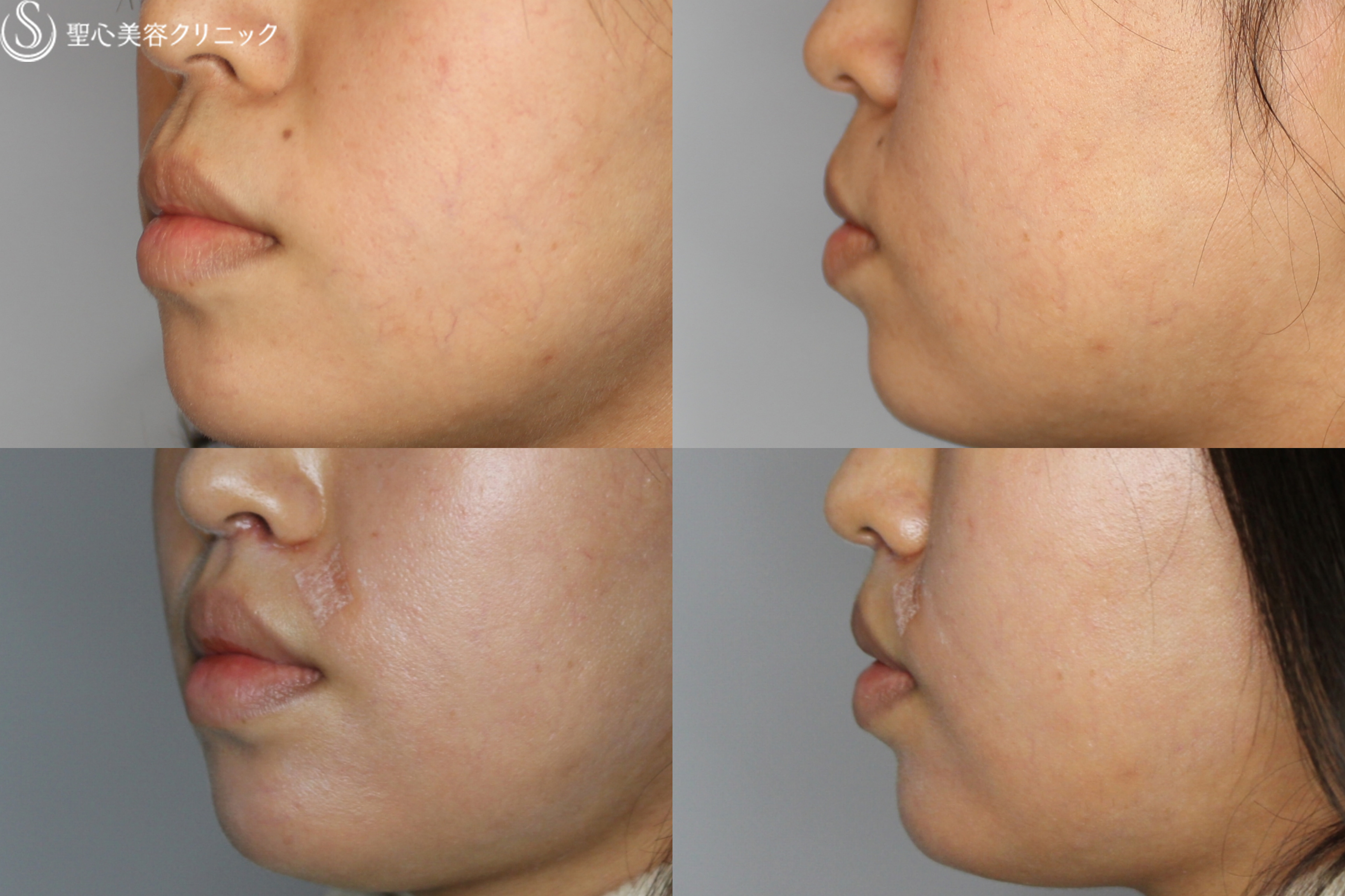 【女性・お顔全体が締まった印象に】鼻下短縮術でバランスを整える（1ヶ月後） After 