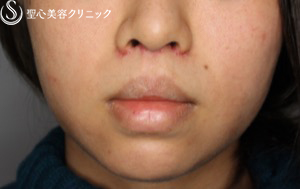 【女性・お顔全体が締まった印象に】鼻下短縮術でバランスを整える（1ヶ月後） After 