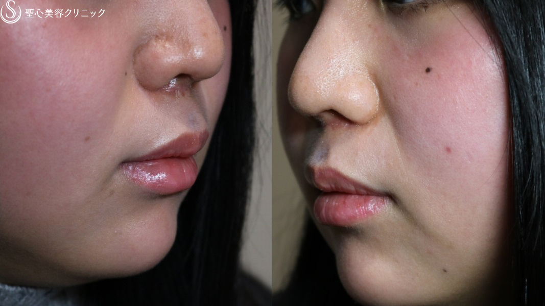 【20代女性・鼻の下を短く】リップリフト（1ヶ月後） After 