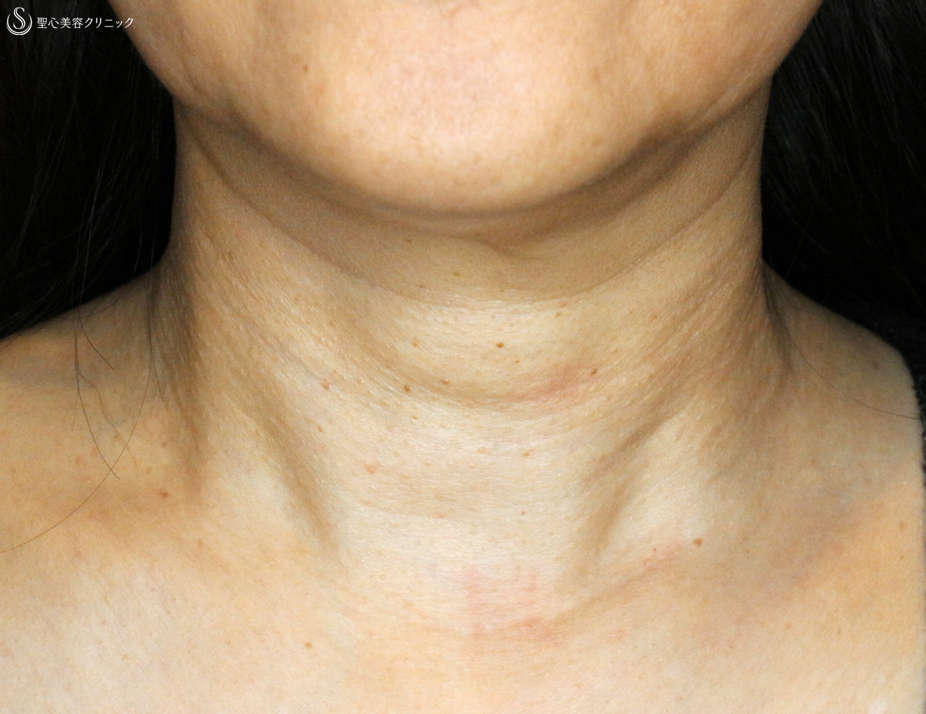 【50代女性・首の横じわ】プレミアムPRP皮膚再生療法（1ヶ月後） Before 
