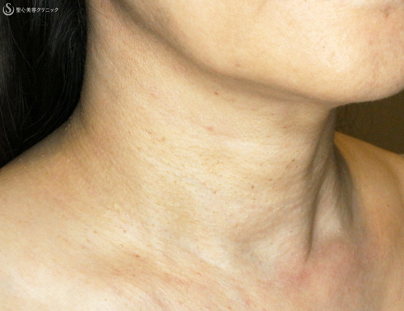 【50代女性・首の横じわ】プレミアムPRP皮膚再生療法（1ヶ月後） After 