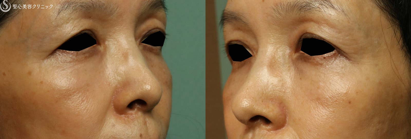 【50代女性・目の上のくぼみを改善】プレミアムPRP皮膚再生療法（4ヶ月後） Before 