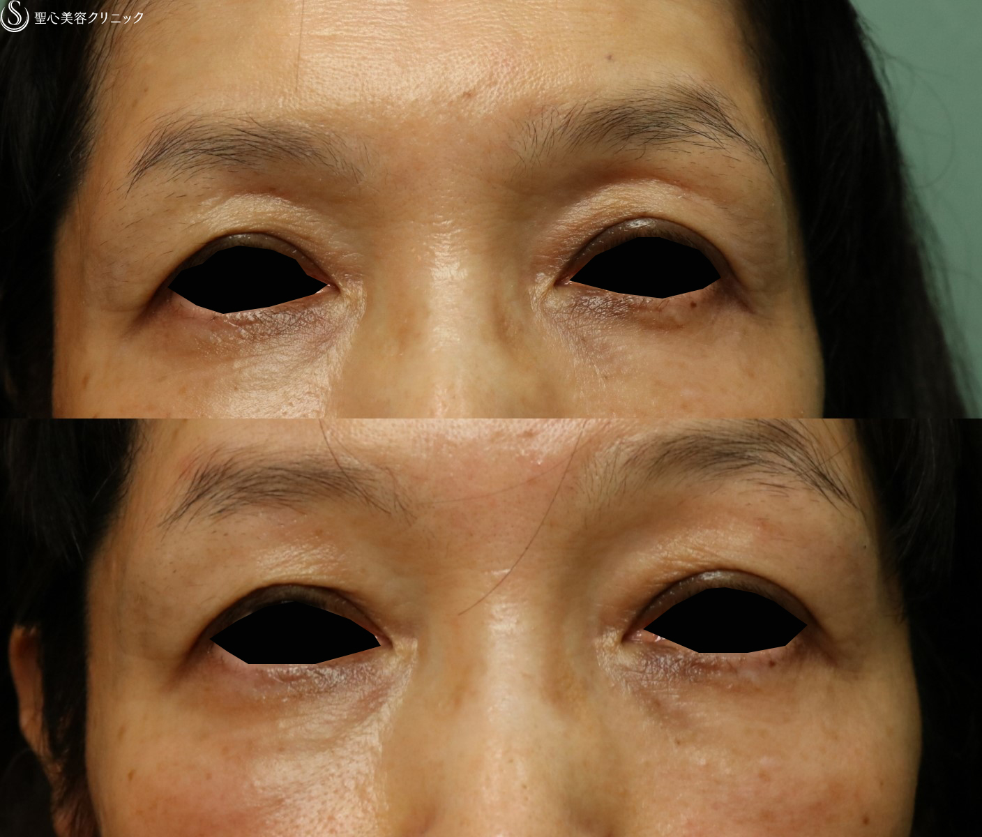 【50代女性・目の上のくぼみを改善】プレミアムPRP皮膚再生療法（4ヶ月後） After 