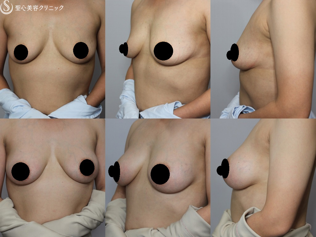 【40代女性・自然で綺麗な形に】豊胸術（MotivaErgonomix185㏄）（1ヶ月後） After 