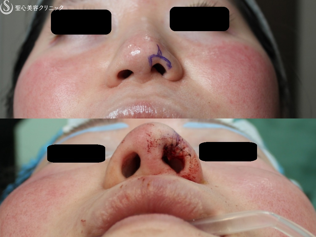 【30代女性・鼻孔左右差を改善】左鼻孔縁修正（皮膚軟骨移植）（1ヶ月後） Before 