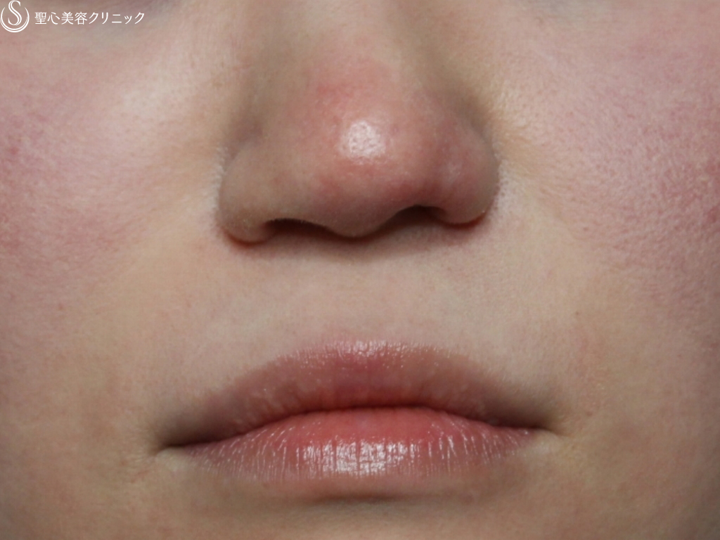 【30代女性・鼻孔左右差を改善】左鼻孔縁修正（皮膚軟骨移植）（1ヶ月後） After 
