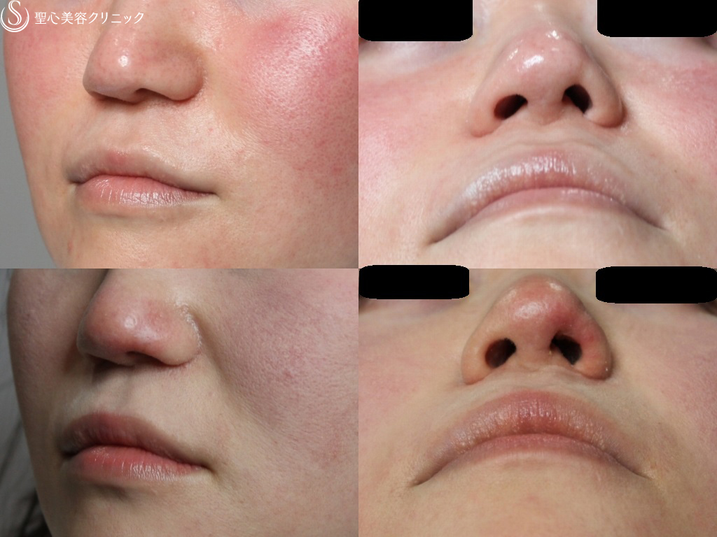 【30代女性・鼻孔左右差を改善】左鼻孔縁修正（皮膚軟骨移植）（1ヶ月後） After 