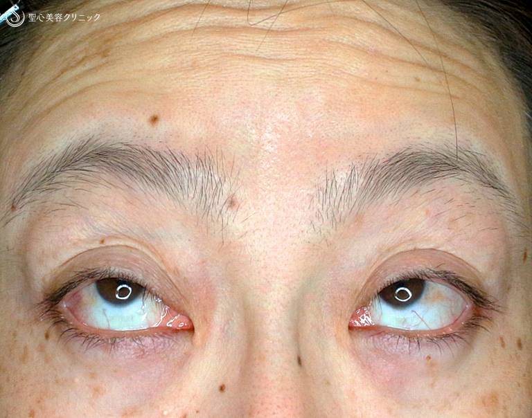 【40代女性・コンタクトレンズによる眼瞼下垂】切らない眼瞼下垂+α法（4ヶ月後） Before 