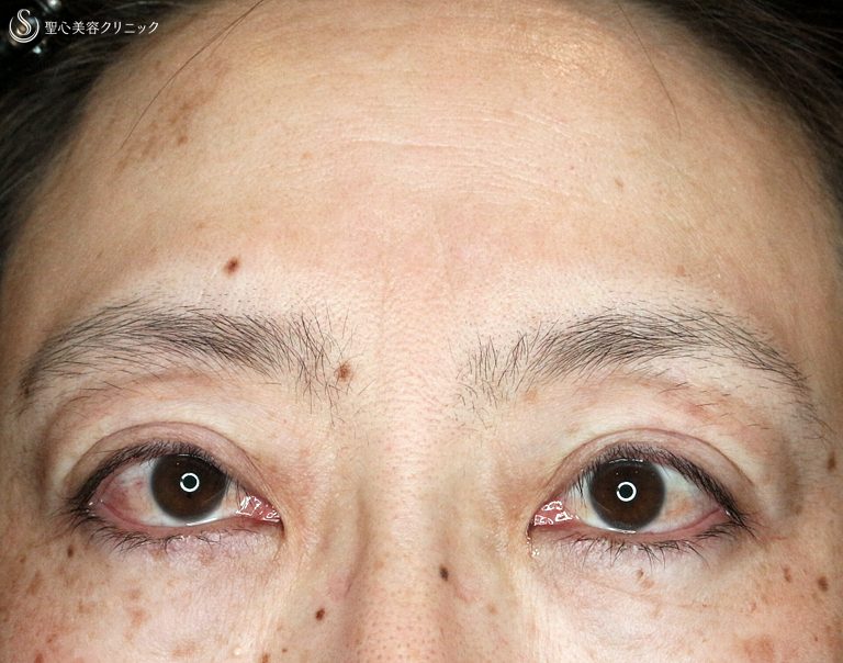 【40代女性・コンタクトレンズによる眼瞼下垂】切らない眼瞼下垂+α法（4ヶ月後） Before 