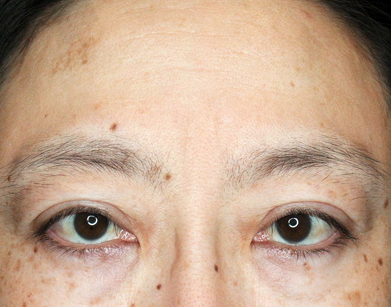 【40代女性・コンタクトレンズによる眼瞼下垂】切らない眼瞼下垂+α法（4ヶ月後） After 