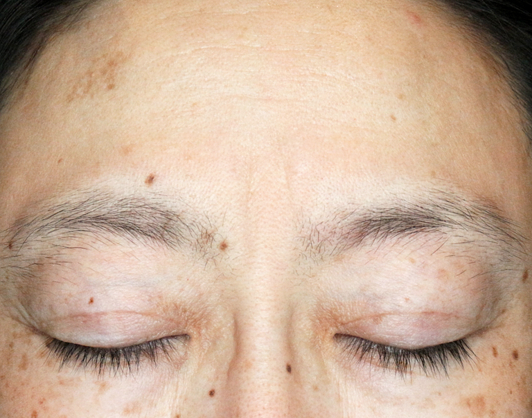 【40代女性・コンタクトレンズによる眼瞼下垂】切らない眼瞼下垂+α法（4ヶ月後） After 
