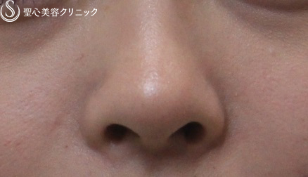 【女性・鼻先の形を整える】鼻先への耳介軟骨移植 After 