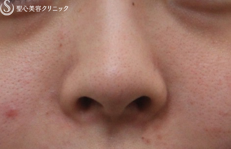 【女性・鼻先の形を整える】鼻先への耳介軟骨移植 Before 