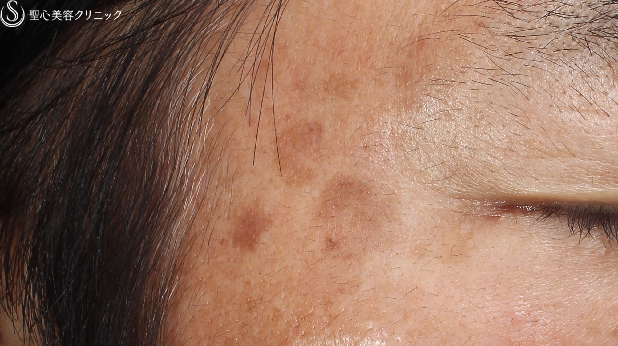 【50代男性・しみ】Q-スイッチYAGレーザー（1ヶ月半後） Before 