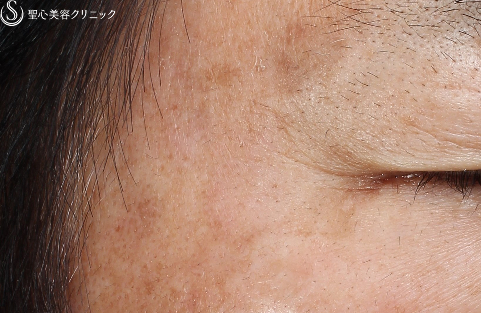 【50代男性・しみ】Q-スイッチYAGレーザー（1ヶ月半後） After 