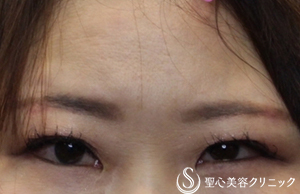 【40代女性・たるみ取りでおでこのシワもすっきりと】眉下切開＆二重埋没法 After 