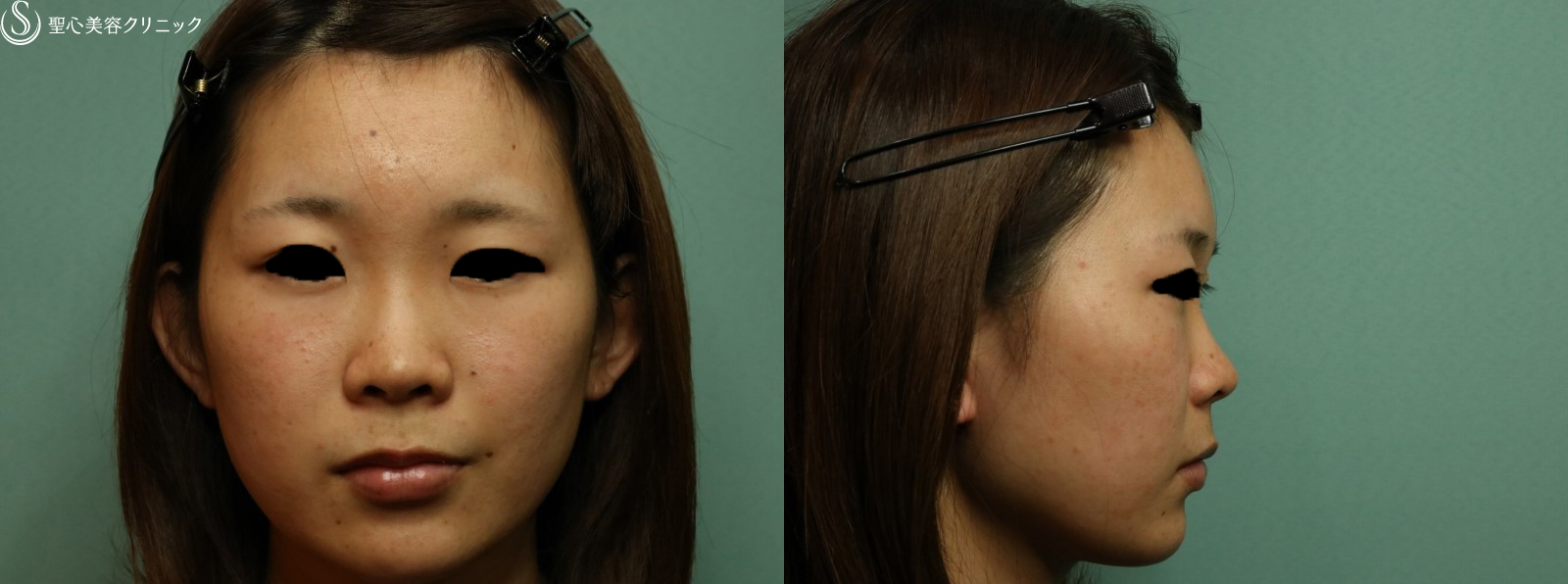 【20代女性・自然に鼻の高さを改善】プロテーゼによる隆鼻術（1ヶ月後） Before 