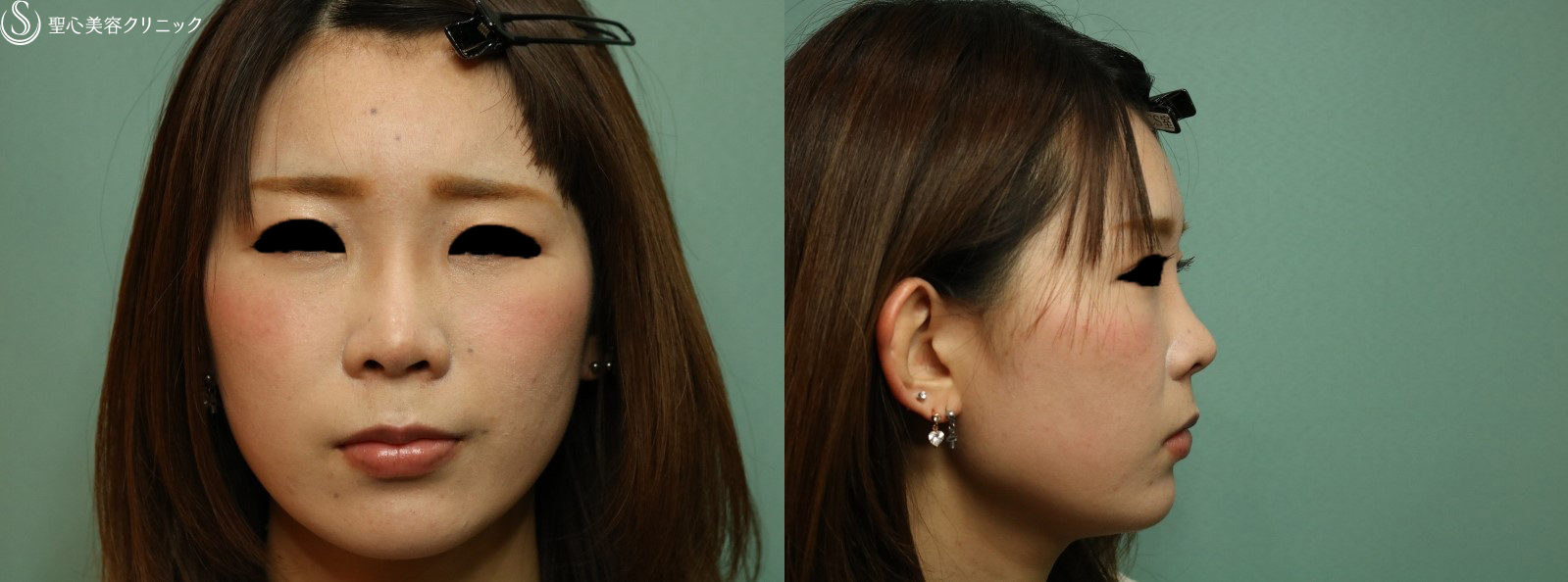 【20代女性・自然に鼻の高さを改善】プロテーゼによる隆鼻術（1ヶ月後） After 