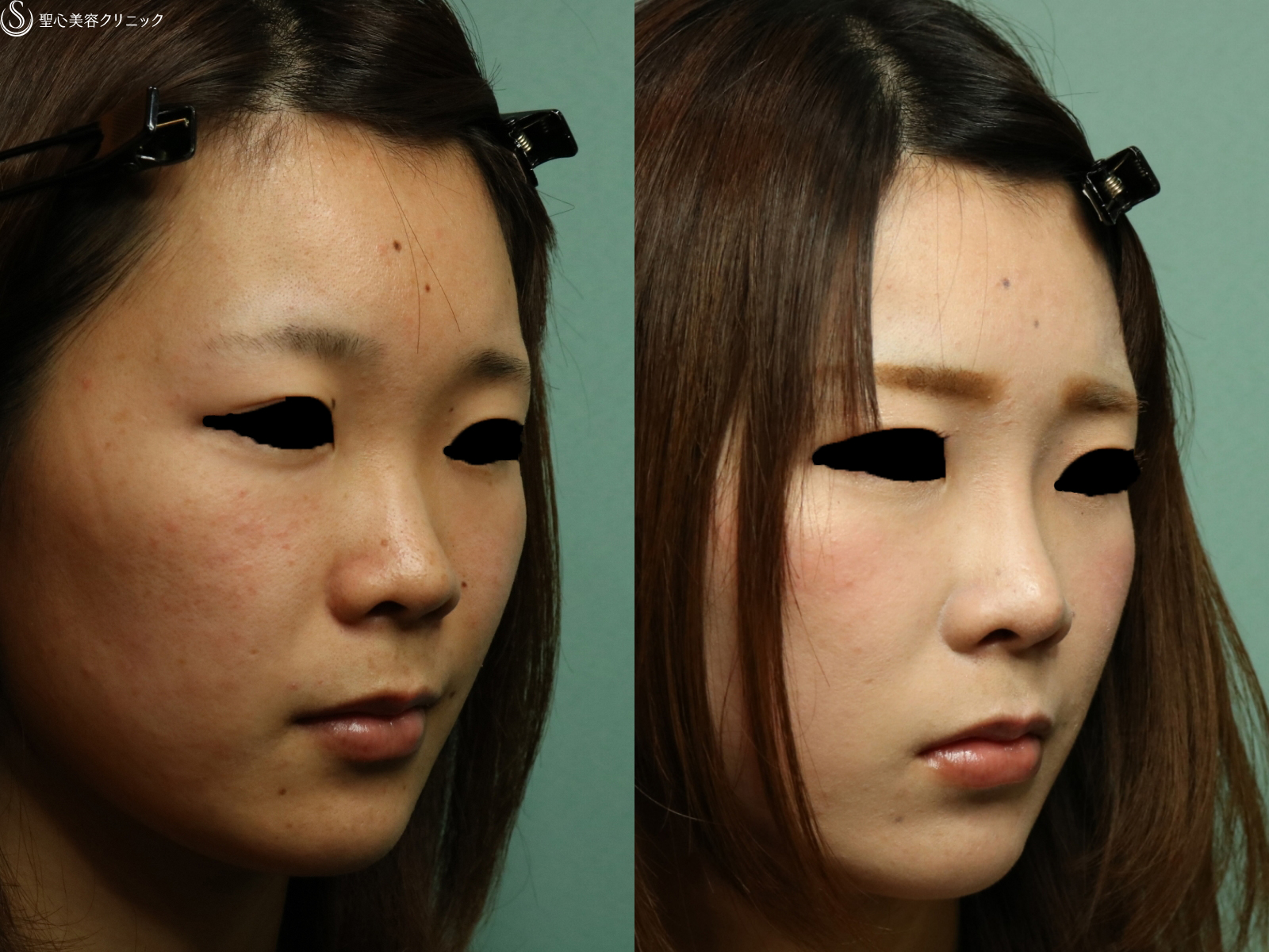 【20代女性・自然に鼻の高さを改善】プロテーゼによる隆鼻術（1ヶ月後） After 