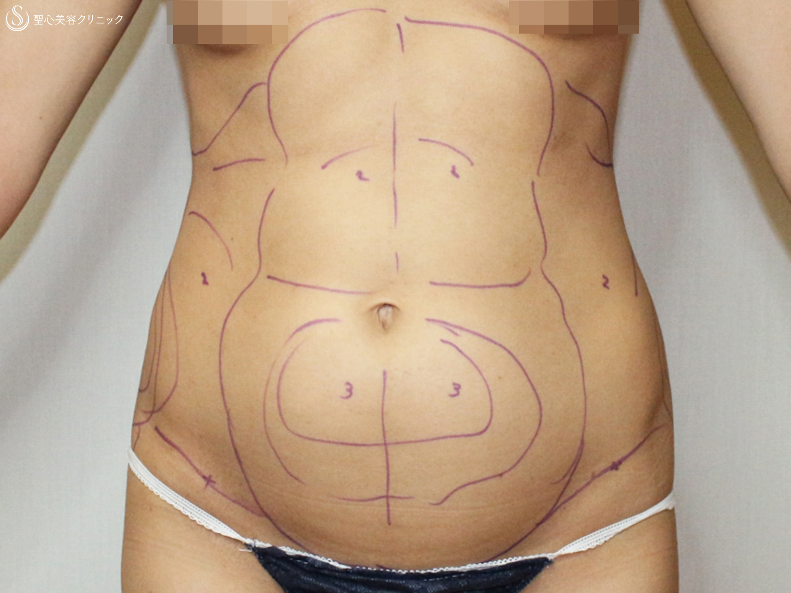 【30代女性・腹筋のプロポーションを出す】ベイザー脂肪吸引（1ヶ月半後） Before 